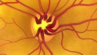 Animation: Detecting glaucoma through a dilated eye exam.