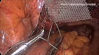 Grade 4 cystocele and hysterocele repair by laparoscopic promontofixation