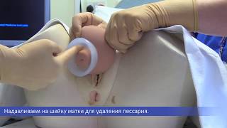 Акушерский пессарий Арабин Извлечение пессария