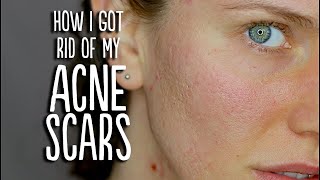 Acne + Scar Update (How I Got Rid Of My Acne Scars)
