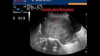 grande utero fibromatoso