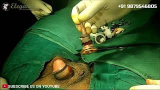 Live Stitchless Circumcision Surgery With Stapler Procedure