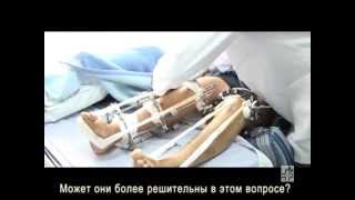 Хирургическое увеличение роста в Армении