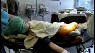 Amphouse Cecilia female RAK surgery stumprevision