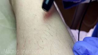 Электроэпиляция ног Донецк