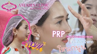 เติมเต็มหน้าผากโหนกนูน(prp jelly จาดเลือดของคนไข้เอง)ด้วยเทคนิคพิเศษ[น้องโบว์]