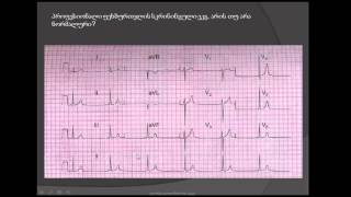 აჩქარებული იდიონოდური რითმი (achqarebuli idionoduri ritmi). მოკლე PQ ინტერვალი. AV დისოციაცია