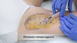 Лечение гипергидроза в Самаре