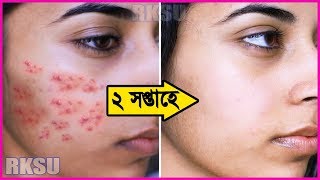 মাত্র ২ সপ্তাহে আধুনিক পদ্ধতিতে স্থায়ীভাবে ব্রনের দাগ সহ ব্রন দূর করার উপায়! মুখ হবে একদম দাগমুক্ত