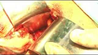 Colecistectomia convencional / Conventional cholecystectomy