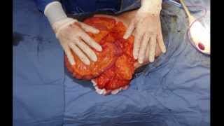 Cáncer de colon. Hemicolectomia derecha (Cirugía radical).