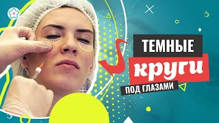 ♥♥ Как убрать ТЕМНЫЕ КРУГИ под глазами?! ♥♥ Коррекция филлерами ♥