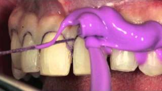 Carillas de porcelana VM7