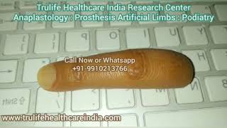 Silicone Finger for Amputee's | Best Prosthetic  Finger India Delhi, UAE,  OMAN, Bangladesh, Nepal