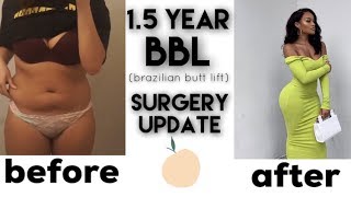 1.5 YEAR BBL UPDATE | REGRETTING MY BRAZILIAN BUTT LIFT | ALLYIAHSFACE