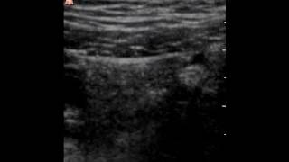 RLQ Pain VScan Evaluation with 9 y.o. Girl