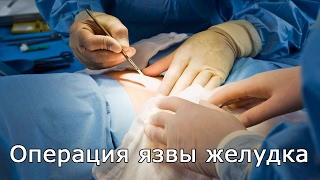 Операция язвы желудка