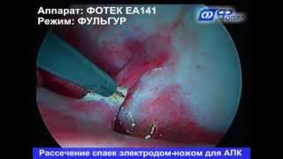 Хирургическое лечение туберкулеза легких