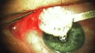 Глаукома. Нейропротекция. Ксенопласт.Glaucoma. Neuroprotection. Xenoplast.