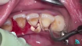 Удаление зубного камня с помощью ультразвука (Removing dental plaque)