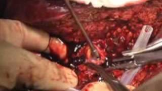 Câncer de Figado. Hepatectomia direita. Right hepatectomy.