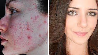 How To Cover Acne & Scars (IF You Want To) | Easy Makeup Transformation Routine