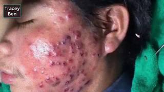 blackheads - remove blackheads - blackhead remover vacuum - acne extraction 2019 HD