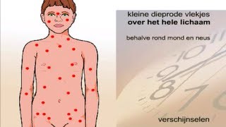 Roodvonk - Symptomen en behandeling