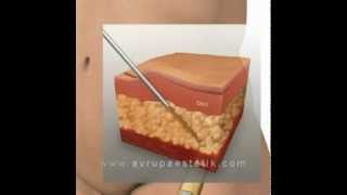 Karından Liposuction ile Yağ Aldırma | Dr. Nazmi Bayçın