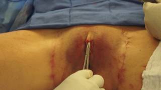 Clitoral Hood Reduction