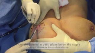 Inverted Nipple correction