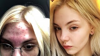 Как избавиться от прыщей