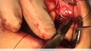 Implant avec greffe d'apposition