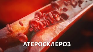На приёме у доктора Бокерия. Атеросклероз | Телеканал Доктор