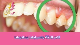 الام اللثة واسبابها وعلاجها|امراض الاسنان|علاج التهاب اللثة والاسنان|امراض الاسنان