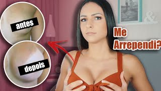 Relato sobre meu SILICONE | arrependida?