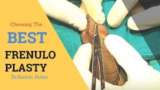 FRENULOPLASTY PROCEDURE VIDEO Dr.Sachin Kuber +919370275336/+919370240098