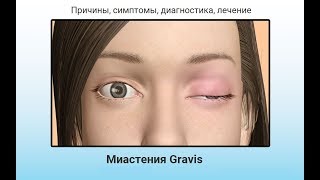 Миастения - симптомы, лечение, причины, диагностика
