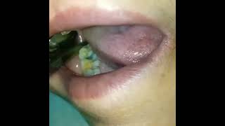 Removing oral sutures