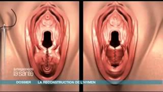 reportage sur hymen