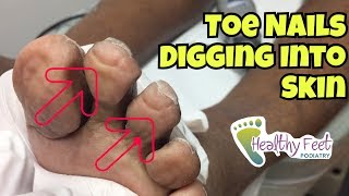 Nails Curling Into Toes - Nail Trimming for Diabetic by Tampa Podiatrist Dr. Binh Nguyen