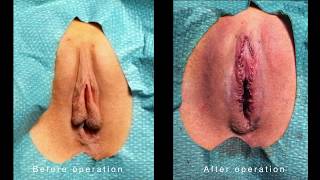 Labiaplasty and Clitoral Hood Operation
