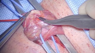 Microsurgical spermatic cord denervation