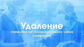 Удаление папиллом на головке полового члена (урологические операции). Без рубцов, без боли.