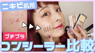 【プチプラコンシーラー5種比較】ニキビ跡を一番カバーしてくれるコンシーラーはどれ！？