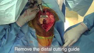 Total Knee Replacement   Instructional video