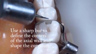 Class II Amalgam Preparation