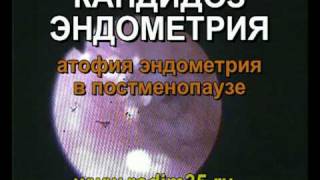 Кандидоз или молочница у женщины. Признаки.