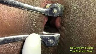 Anal Fissure Surgery Technique: Lateral Internal Sphincterotomy