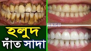 দাঁতের হলুদ ও দাঁতের কালো দাগ দূর করার উপায় / মুক্তোর মতো সাদা ১০০% কার্যকারী/Beauty Tips Bangla